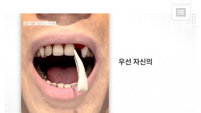 치아를 눈에 넣어 실명을 치료하는 안구 내 치아 수술 